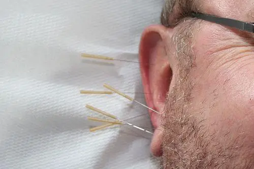 Akupunktur:: Akupunktur Heilpraktiker Achterwehr